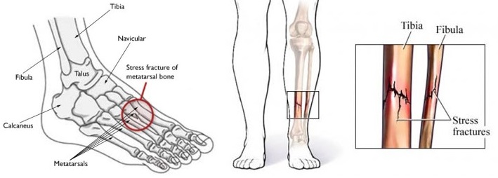 What Does A Stress Fracture Feel Like New Health Advisor